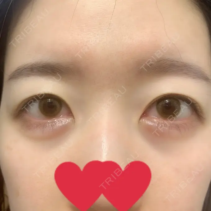 二重切開 / 目頭切開 心斎橋コムロ美容外科クリニック BEFORE メイン用