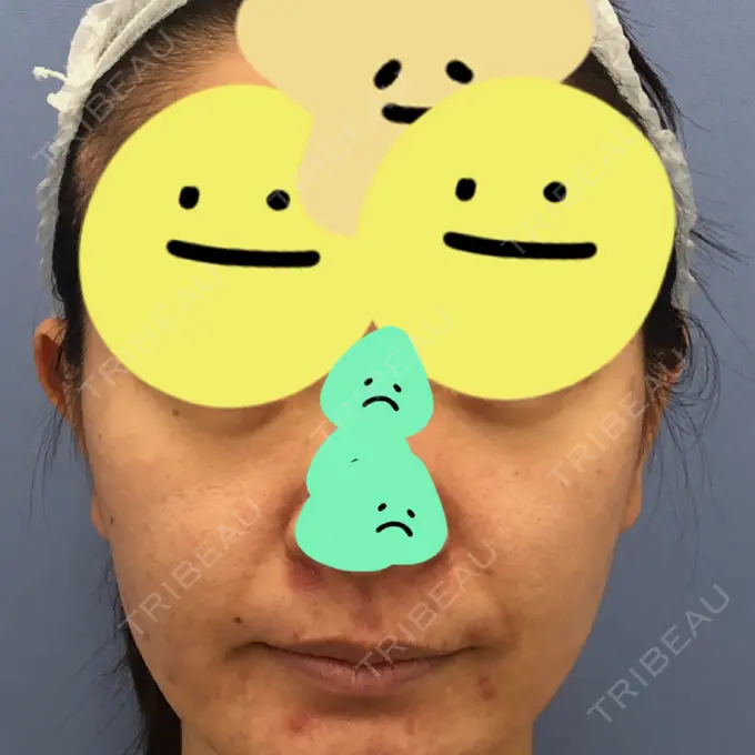 糸リフト / 脂肪吸引（顔） / 脂肪注入（肌） / メーラーファット除去 / ボトックス（エラ・小顔） 湘南美容クリニック 秋葉原院 BEFORE メイン用