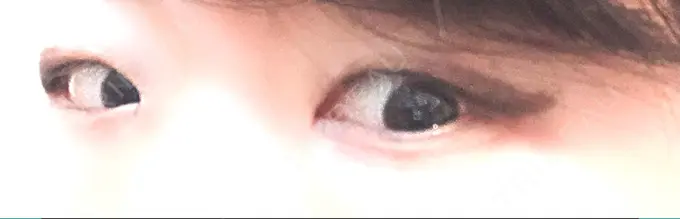 二重埋没 きくな湯田眼科 BEFORE メイン用