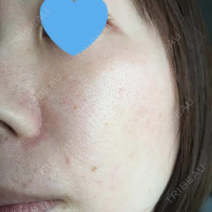 毛穴洗浄（ハイドラフェイシャルなど） / ピコレーザートーニング（美白・肝斑） / フラクショナルレーザー（毛穴・ニキビ跡） B-LINE CLINIC 池袋院 BEFORE メイン用