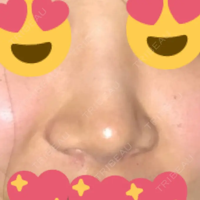 鼻尖形成（切開） / 小鼻縮小（切開） / 軟骨移植 / ワシ鼻修正・ハンプ切除 / 鼻尖縮小 / その他（鼻） B-LINE CLINIC 池袋院 BEFORE メイン用