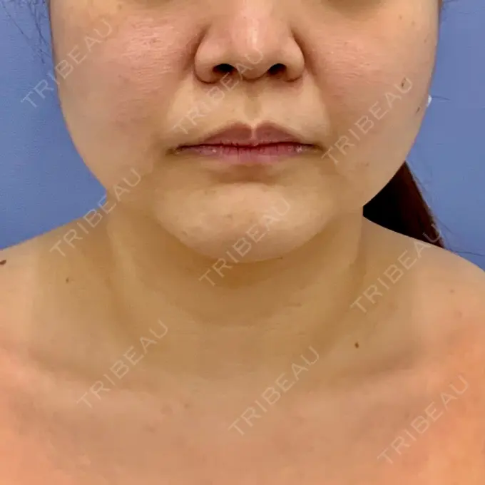 糸リフト / バッカルファット除去 / 脂肪吸引（顔） / メーラーファット除去 / ボトックス（エラ・小顔） 湘南美容クリニック 秋葉原院 BEFORE メイン用