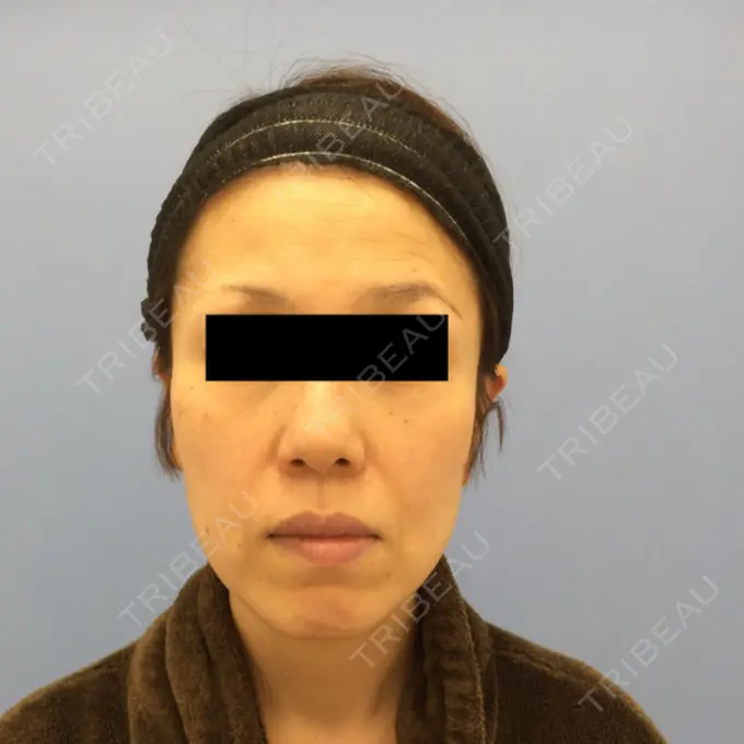 糸リフト / 脂肪吸引（顔） / 脂肪注入（肌） 湘南美容クリニック 秋葉原院 BEFORE メイン用