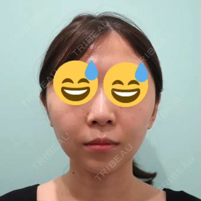 糸リフト / 脂肪吸引（顔） / ボトックス（あご） WOM CLINIC GINZA （ワム クリニック ギンザ） BEFORE メイン用