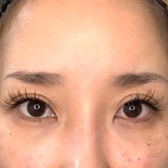 目頭切開 / 糸リフト / 目尻切開 / タレ目形成・グラマラスライン（切開） / メーラーファット除去 / ヒアルロン酸注入（涙袋） / ヒアルロン酸注入（あご） / ヒアルロン酸注入（唇） / ボトックス（口角） 大阪TAクリニック BEFORE メイン用