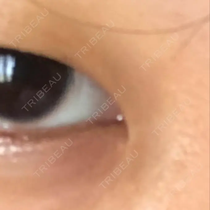 二重埋没 / 目頭切開 ドクター松井クリニック 新宿 BEFORE メイン用