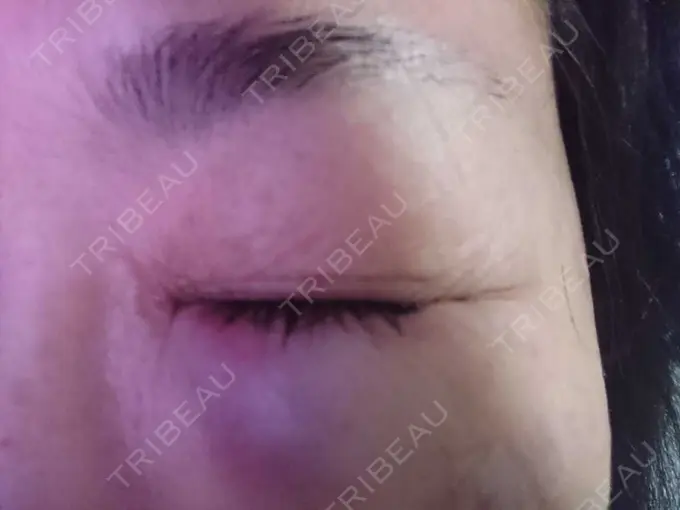 下まぶたたるみ取り / その他 湘南美容クリニック 千葉センシティ院 BEFORE メイン用