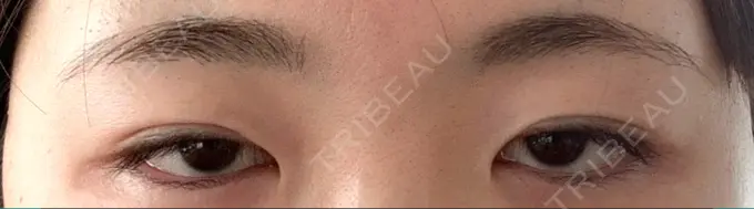 二重切開 / 上まぶたの脂肪取り / その他（目元） CLASSY 仙台美容外科・美容皮膚科 BEFORE メイン用