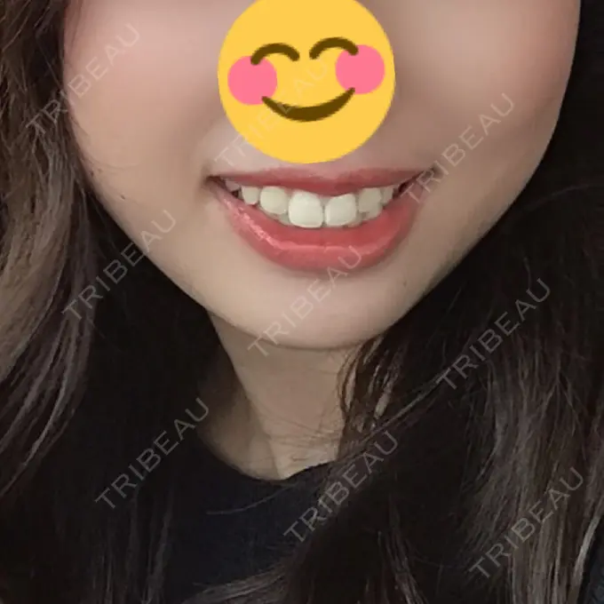 脂肪溶解注射（顔） 大西皮フ科形成外科医院 滋賀大津石山院 BEFORE メイン用