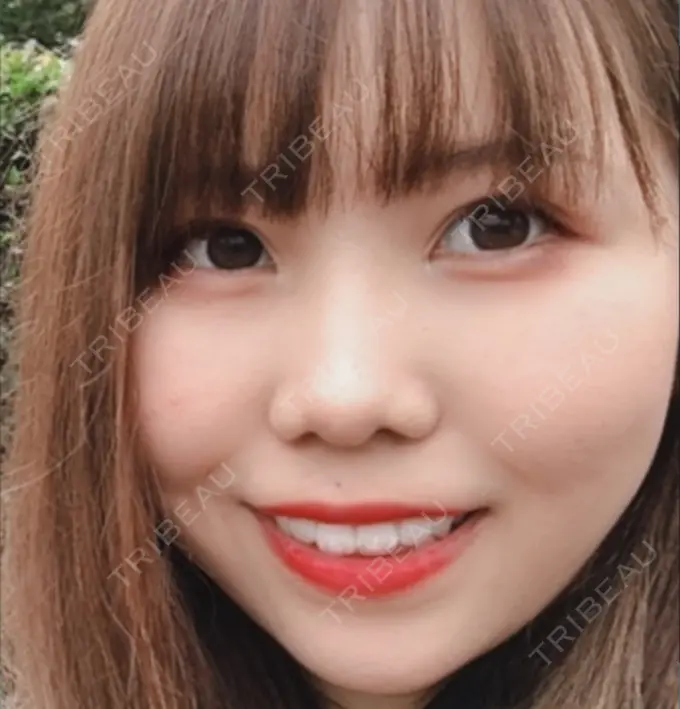 鼻尖形成（切開） / 鼻中隔延長（切開） / 軟骨移植 / 鼻孔縁下降 / その他（鼻） 湘南美容クリニック 新宿本院 BEFORE メイン用