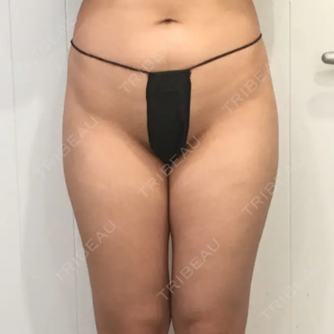 脂肪吸引（二の腕） / 脂肪吸引（脚） / 脂肪吸引（お腹） ヨンセスリムライン BEFORE メイン用