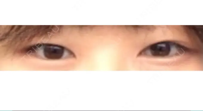 二重埋没 共立美容外科 大宮院 BEFORE メイン用