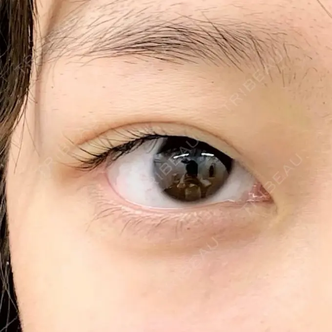 二重埋没 R Beauty CLINIC 銀座院 BEFORE メイン用