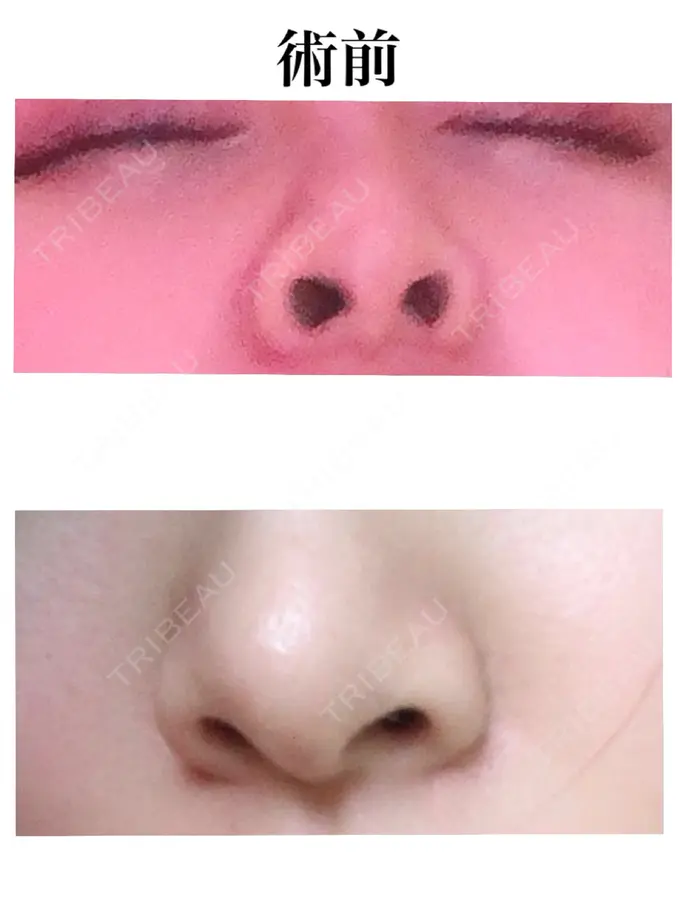 小鼻縮小（切開） / 軟骨移植 / 鼻尖縮小 麹町皮ふ科・形成外科クリニック BEFORE メイン用