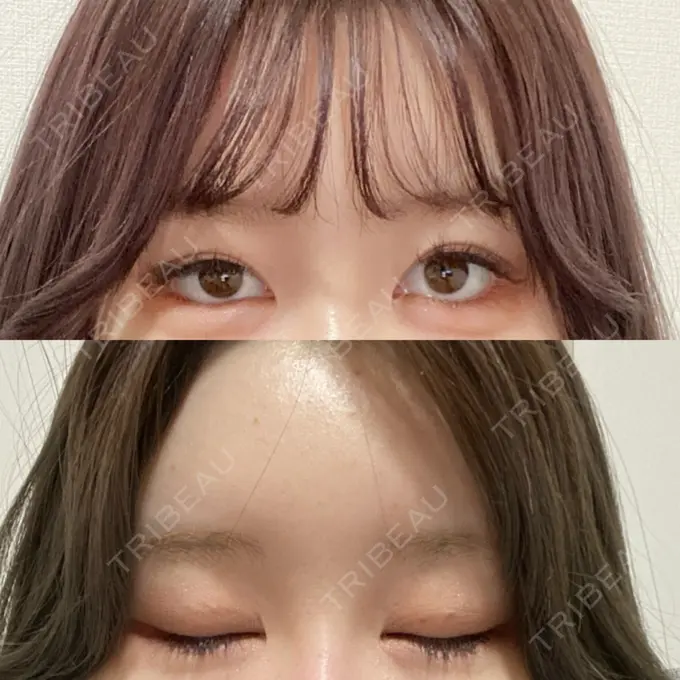 二重埋没 CLASSY 仙台美容外科・美容皮膚科 BEFORE メイン用