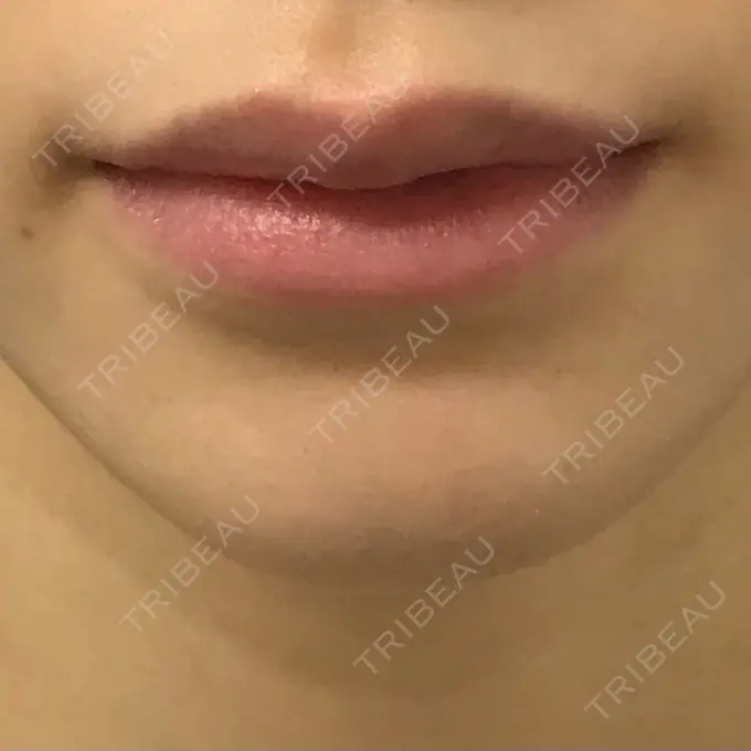 ヒアルロン酸注入（唇） / ボトックス（口角） ルラ美容クリニック 新宿院 BEFORE メイン用