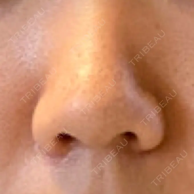 鼻孔縁挙上 シエルクリニック BEFORE メイン用