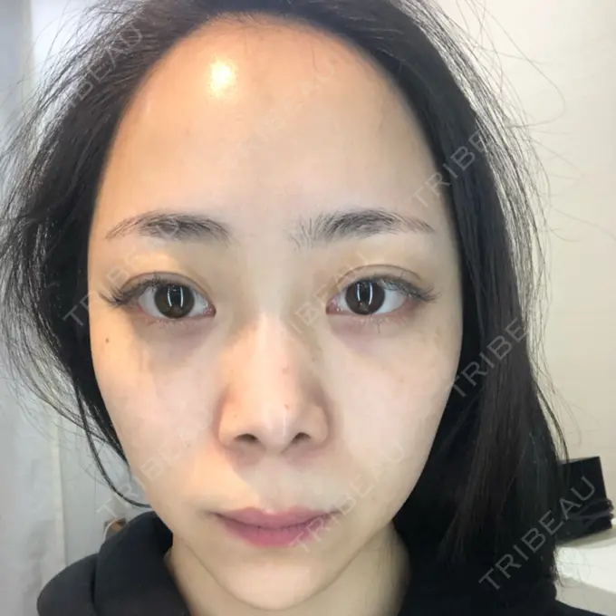 ほくろ・いぼ切除（肌） / シミ取りレーザー / ピコレーザートーニング（美白・肝斑） セオリークリニック BEFORE メイン用