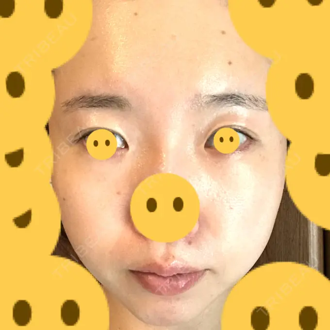 クマ治療 / 上まぶたたるみ取り / 下まぶたたるみ取り / シミ取りレーザー 赤坂プレミアクリニック BEFORE メイン用