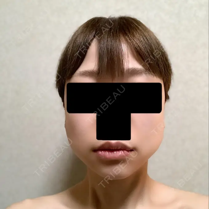 バッカルファット除去 / ボトックス（エラ・小顔） 湘南美容クリニック 金山院 BEFORE メイン用