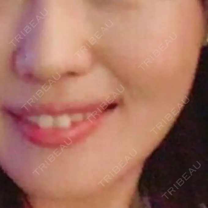 美肌レーザー / ほくろ・いぼ除去レーザー（肌） ニューセンス皮膚科クリニック BEFORE メイン用