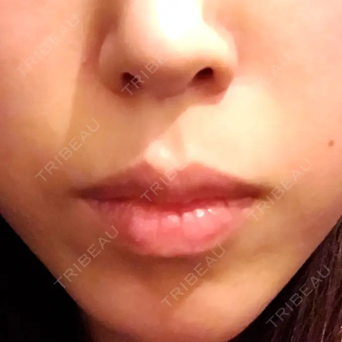 口角挙上 / その他（口元） eクリニック 金沢本院 BEFORE メイン用