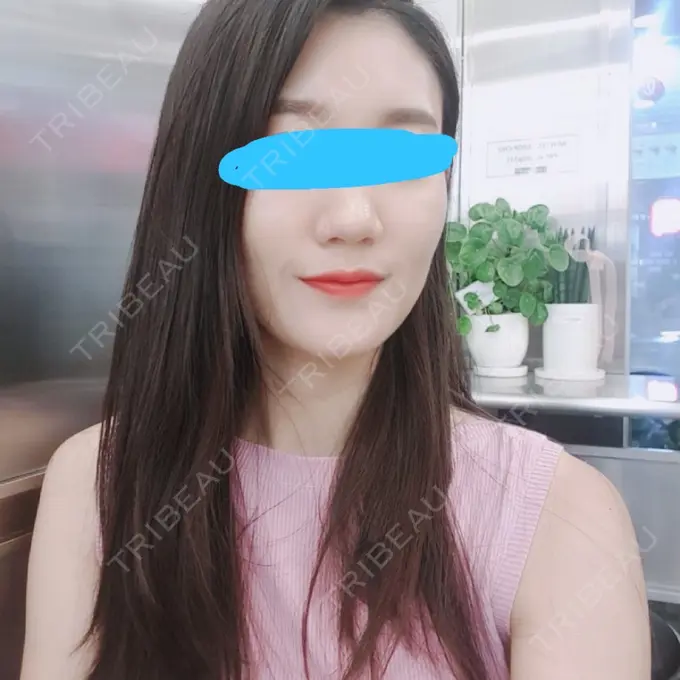 脂肪注入（輪郭） スノウ（Snow）整形外科 BEFORE メイン用