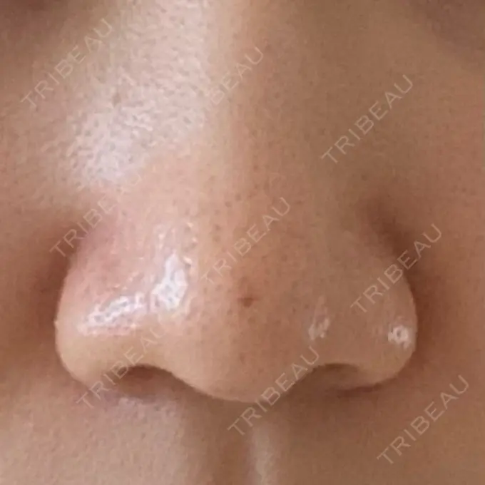 小鼻縮小（切開） 三輪皮フ科形成外科 BEFORE メイン用
