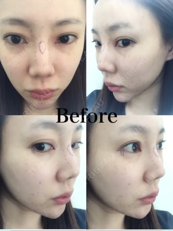 目頭切開 / 糸リフト / あごプロテーゼ / バッカルファット除去 / 目尻切開 / 軟骨移植 / 眉間プロテーゼ / ヒアルロン酸注入（涙袋） / その他（鼻） ミナ美容外科 BEFORE メイン用