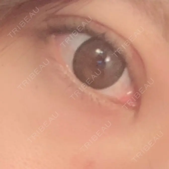 ヒアルロン酸注入（涙袋） プライベートスキンクリニック 梅田本院 BEFORE メイン用