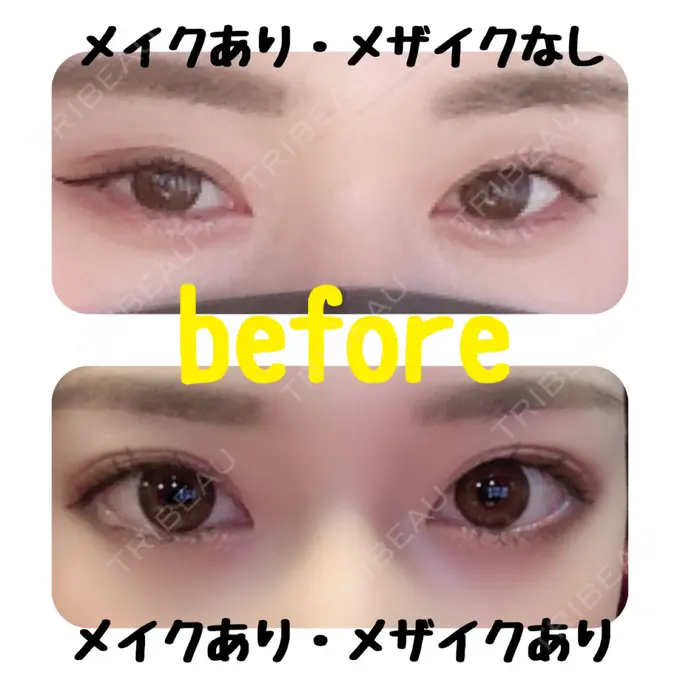 二重埋没 ハナビューティークリニック BEFORE メイン用