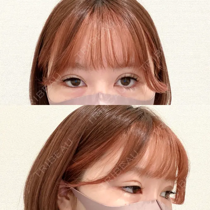 二重埋没 / その他（目元） CLASSY 仙台美容外科・美容皮膚科 BEFORE メイン用