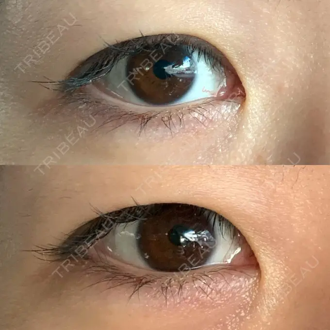 二重埋没 札幌ル・トロワ ビューティクリニックVogue BEFORE メイン用