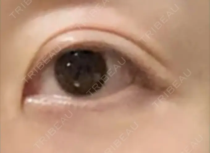 眼瞼下垂（切開） 銀座すみれの花 形成クリニック BEFORE メイン用
