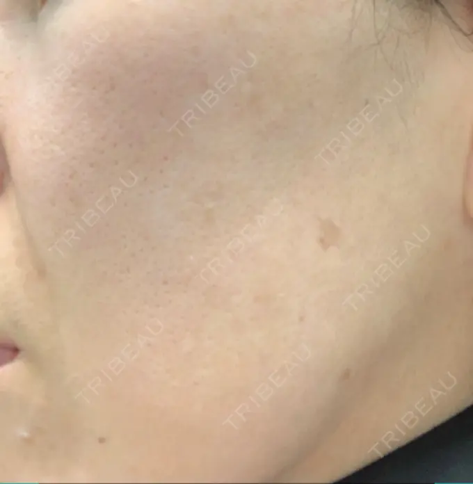 ピーリング（ニキビ・毛穴） / イオン導入 / エレクトロポレーション / 毛穴洗浄（ハイドラフェイシャルなど） あおばクリニック 横浜院 BEFORE メイン用