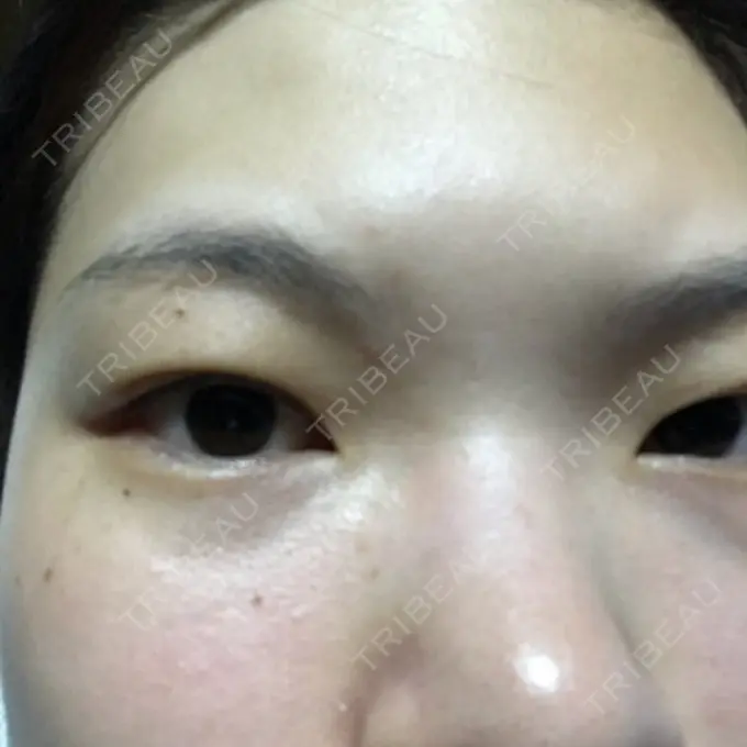 二重切開 / 上まぶたたるみ取り / 上まぶたの脂肪取り 城本クリニック 豊橋院 BEFORE メイン用