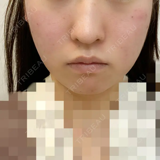 糸リフト / ボトックス（あご） / 肌ヒアルロン酸注入（たるみ・シワ改善） / ヒアルロン酸注入（あご） / ヒアルロン酸注入（唇） / ボトックス（口角） ルラ美容クリニック 新宿院 BEFORE メイン用