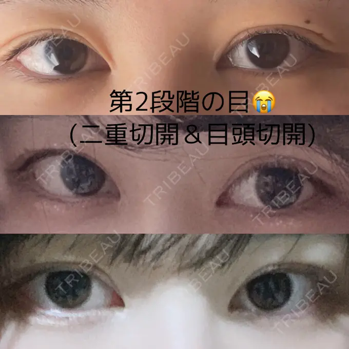 蒙古ひだ形成 R.O.clinic BEFORE メイン用