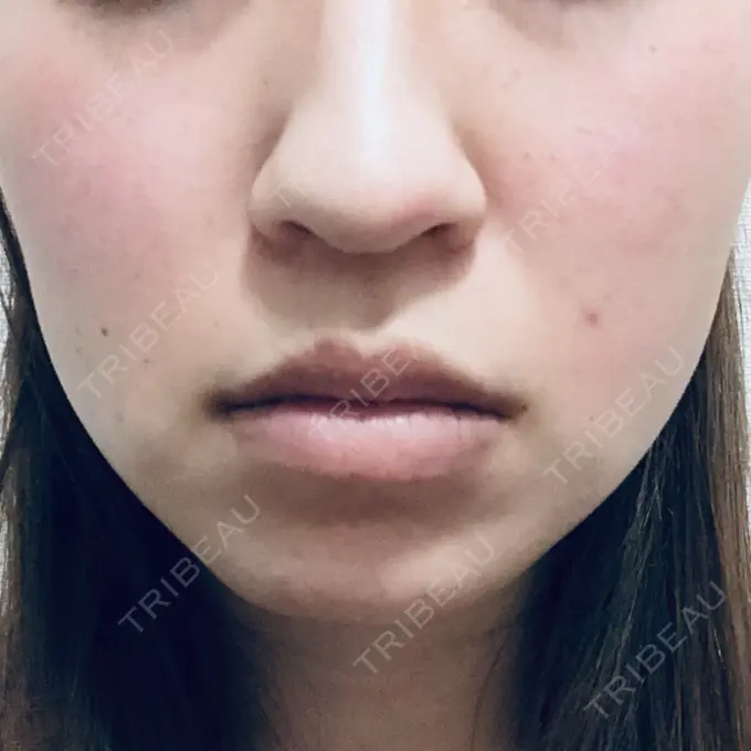 糸リフト 湘南美容クリニック 東京蒲田院 BEFORE メイン用