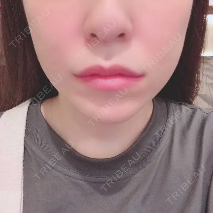 脂肪吸引（顔） みずほクリニック BEFORE メイン用