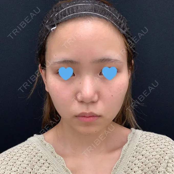 隆鼻術 / 鼻尖形成（切開） / 鼻中隔延長（切開） / 軟骨移植 湘南美容クリニック 名古屋栄院 BEFORE メイン用