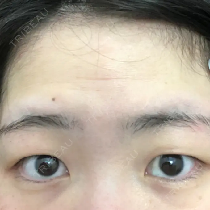 二重埋没 / 二重切開 / 矯正（ワイヤー） 湘南美容クリニック 橋本院 BEFORE メイン用