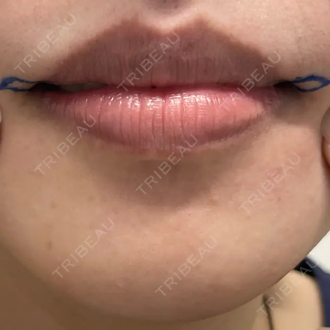 口角挙上 eクリニック 金沢本院 BEFORE メイン用