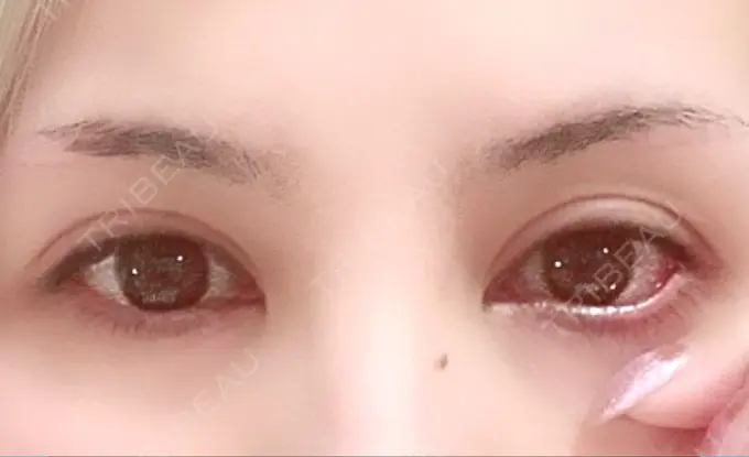 目尻切開 / タレ目形成・グラマラスライン（切開） 高須クリニック 大阪院 BEFORE メイン用
