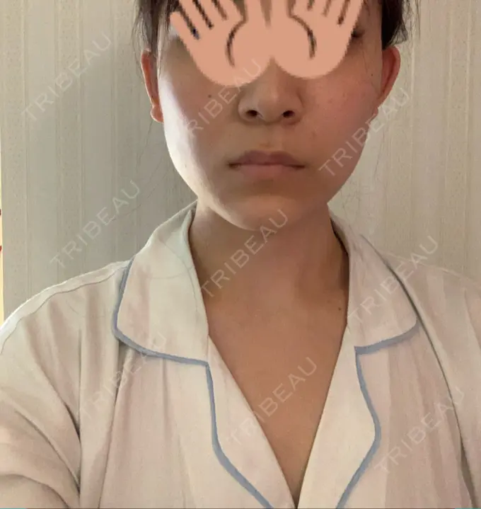 骨切り（あご） / 骨削り（エラ） / 骨削り（頬） / 脂肪吸引（顔） アーククリニック BEFORE メイン用
