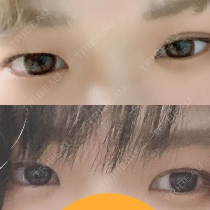 二重埋没 湘南美容クリニック 橋本院 BEFORE メイン用