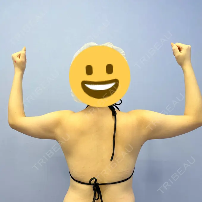 脂肪吸引（二の腕） 湘南美容クリニック 新橋銀座口院 BEFORE メイン用