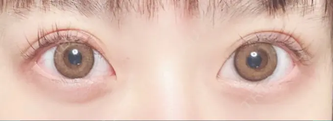 ヒアルロン酸注入（涙袋） 湘南美容クリニック 大阪あべの院 BEFORE メイン用