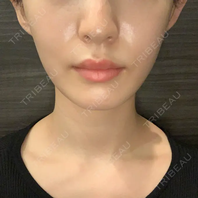 ボトックス（肩） ルラ美容クリニック 新宿院 BEFORE メイン用