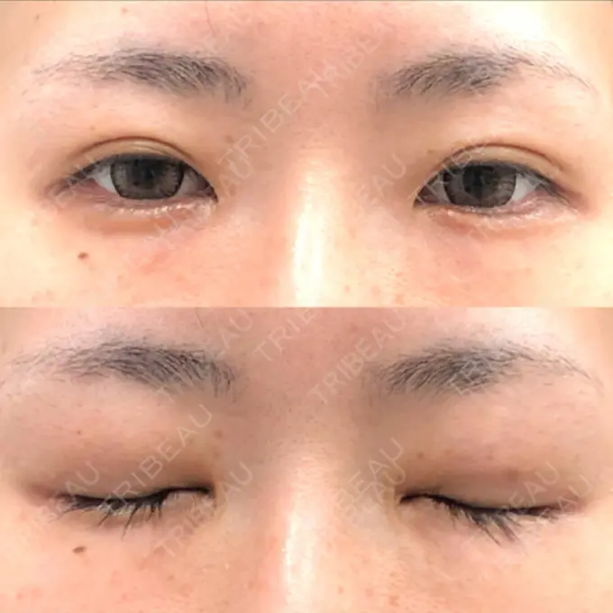 目尻切開 / タレ目形成・グラマラスライン（切開） A CLINIC（エークリニック） 横浜院 BEFORE メイン用